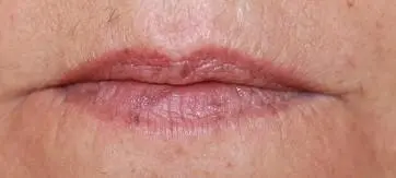 Kräftige Lippen mit Lippenvergrößerung Vorher